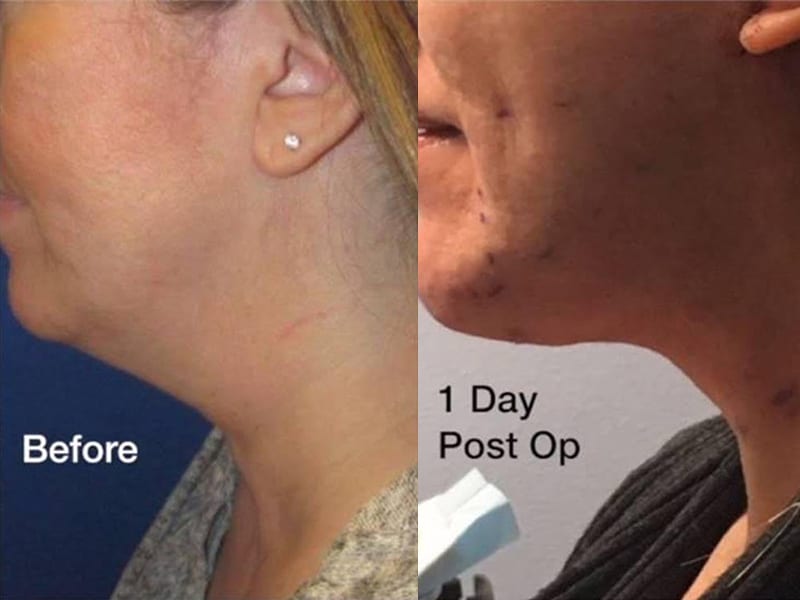 before and after 1 day results