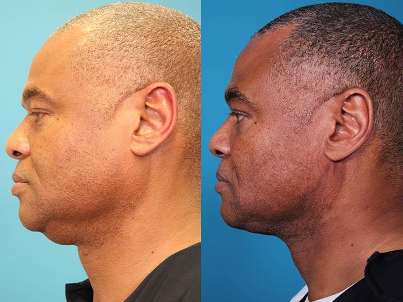 before and after results male patient