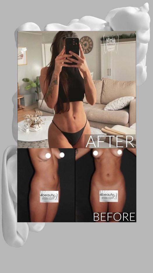 before and after liposuction