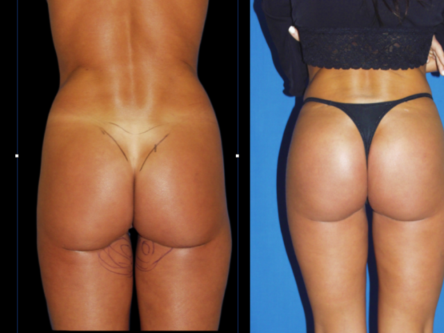 Brazilian Butt Lift