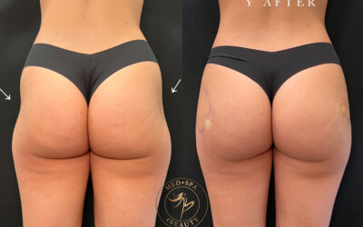 Hate Your Hip Dips? Here Are Your Options