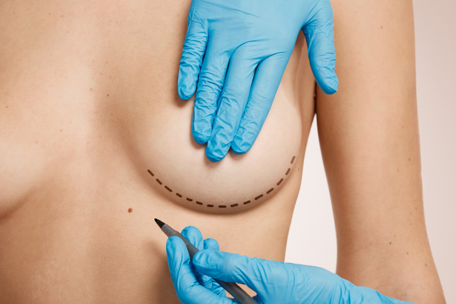 breast-implants-miami Breast Implants in Miami