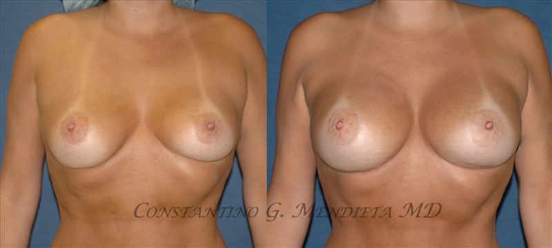 Breast Implant Revision before-and-after photo — 4Beauty Aesthetic Institute