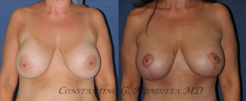 Breast Implant Revision before-and-after photo — 4Beauty Aesthetic Institute