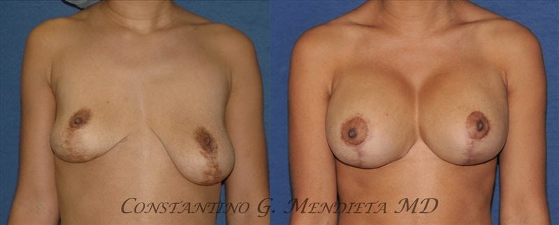 Breast Implant Revision before-and-after photo — 4Beauty Aesthetic Institute