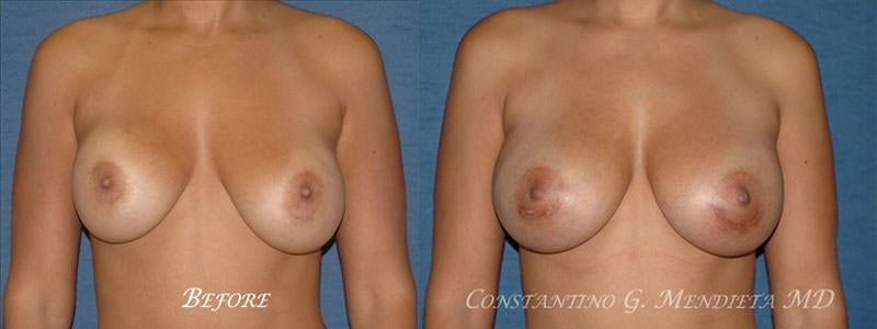 Breast Implant Revision before-and-after photo — 4Beauty Aesthetic Institute