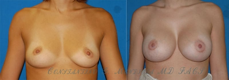 Breast Augmentation before-and-after photo — 4Beauty Aesthetic Institute