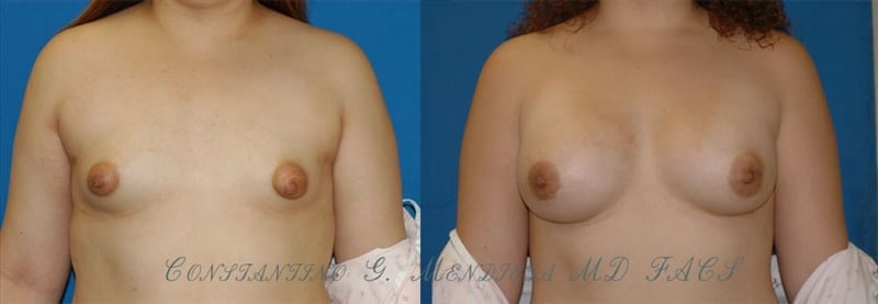 Breast Augmentation before-and-after photo — 4Beauty Aesthetic Institute