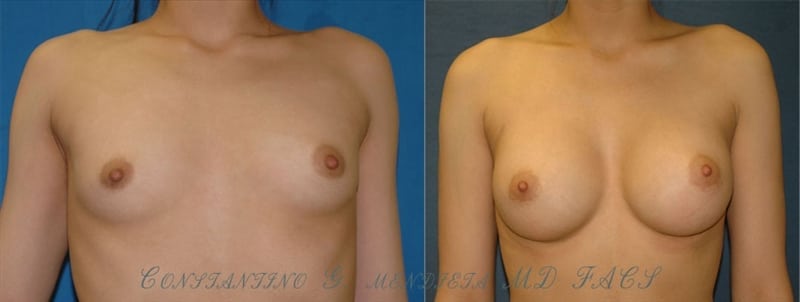 Breast Augmentation before-and-after photo — 4Beauty Aesthetic Institute