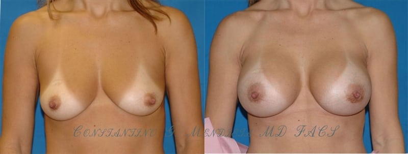 Breast Augmentation before-and-after photo — 4Beauty Aesthetic Institute