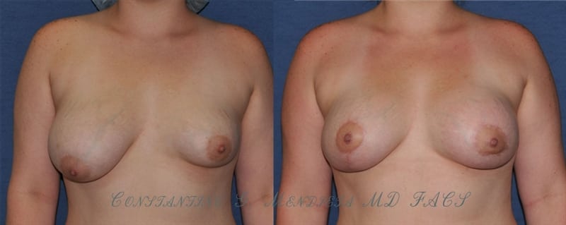 Breast Augmentation before-and-after photo — 4Beauty Aesthetic Institute