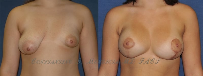 Breast Augmentation before-and-after photo — 4Beauty Aesthetic Institute