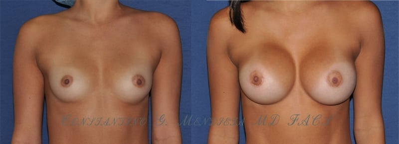 Breast Augmentation before-and-after photo — 4Beauty Aesthetic Institute