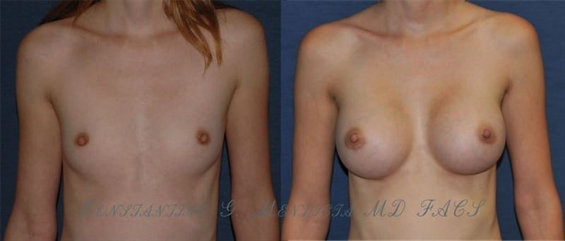 Breast Augmentation before-and-after photo — 4Beauty Aesthetic Institute
