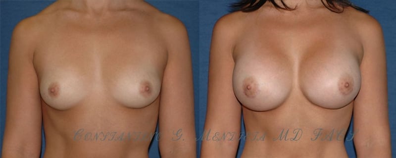 Breast Augmentation before-and-after photo — 4Beauty Aesthetic Institute