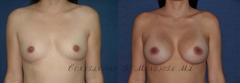 Breast Augmentation before-and-after photo — 4Beauty Aesthetic Institute