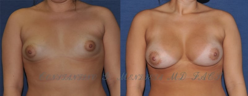 Breast Augmentation before-and-after photo — 4Beauty Aesthetic Institute