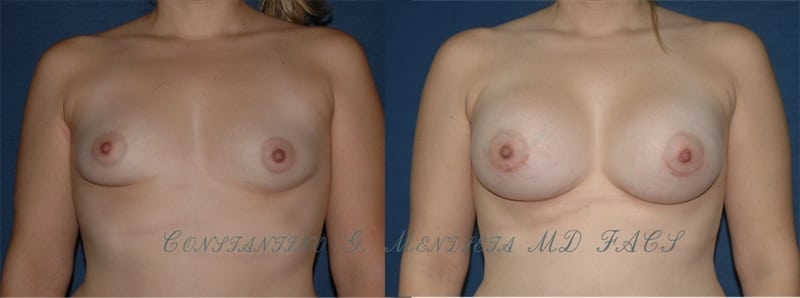 Breast Augmentation before-and-after photo — 4Beauty Aesthetic Institute