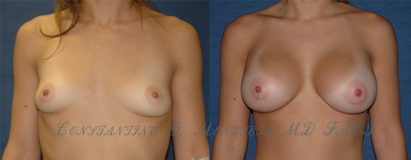 Breast Augmentation before-and-after photo — 4Beauty Aesthetic Institute