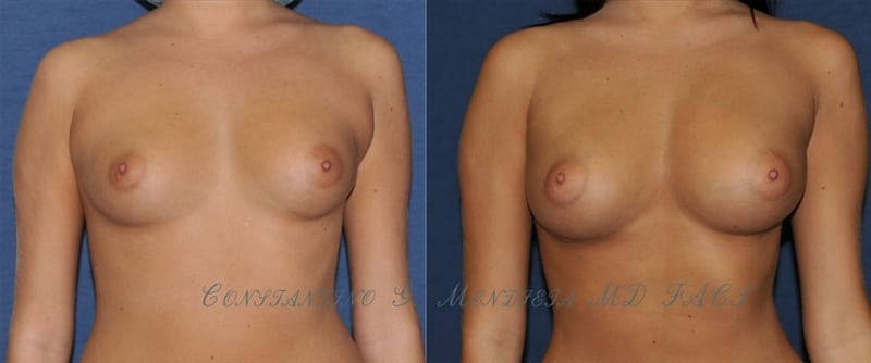 Breast Augmentation before-and-after photo — 4Beauty Aesthetic Institute