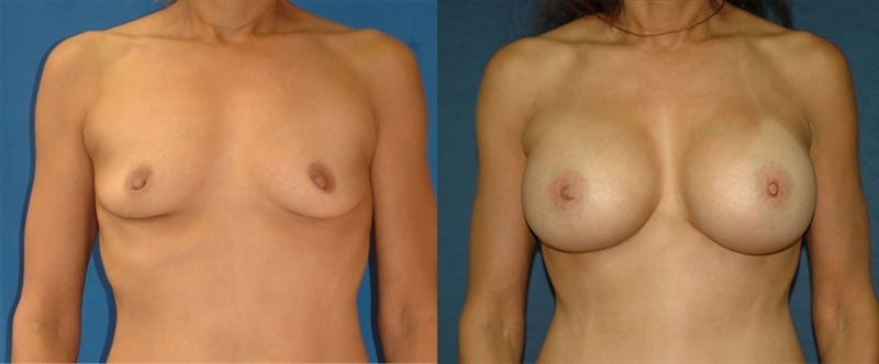 Breast Augmentation before-and-after photo — 4Beauty Aesthetic Institute
