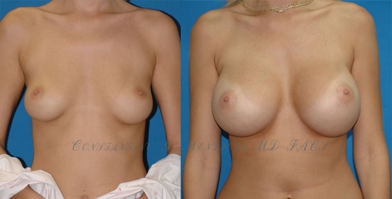 Breast Augmentation before-and-after photo — 4Beauty Aesthetic Institute