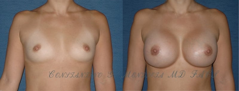 Breast Augmentation before-and-after photo — 4Beauty Aesthetic Institute