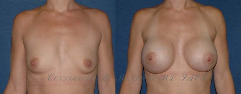 Breast Augmentation before-and-after photo — 4Beauty Aesthetic Institute