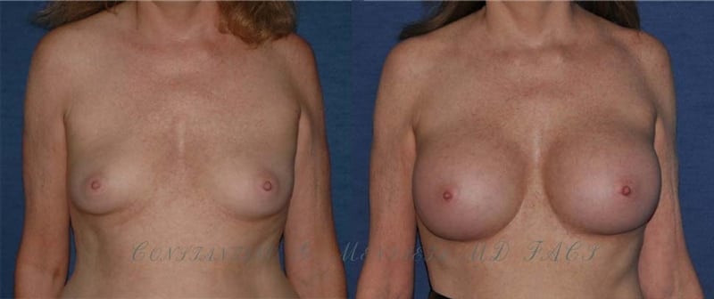 Breast Augmentation before-and-after photo — 4Beauty Aesthetic Institute
