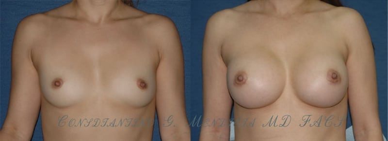 Breast Augmentation before-and-after photo — 4Beauty Aesthetic Institute