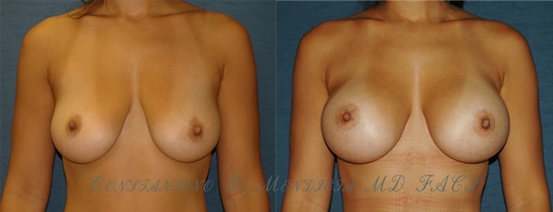 Breast Augmentation before-and-after photo — 4Beauty Aesthetic Institute