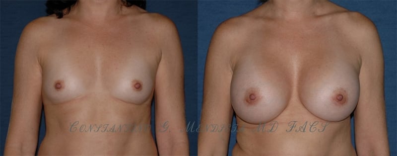 Breast Augmentation before-and-after photo — 4Beauty Aesthetic Institute
