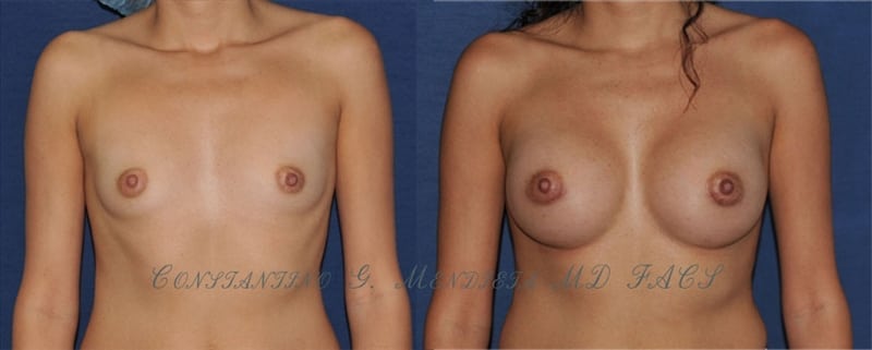 Breast Augmentation before-and-after photo — 4Beauty Aesthetic Institute