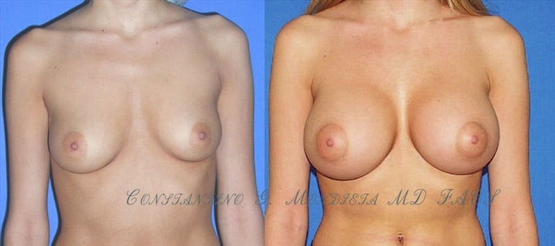 Breast Augmentation before-and-after photo — 4Beauty Aesthetic Institute