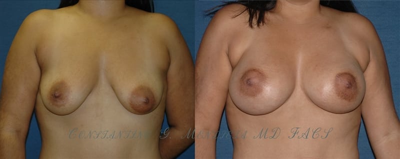 Breast Augmentation with Lift before-and-after photo — 4Beauty Aesthetic Institute