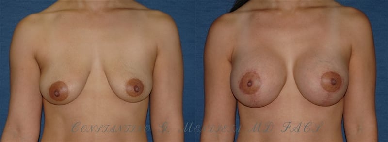 Breast Augmentation with Lift before-and-after photo — 4Beauty Aesthetic Institute