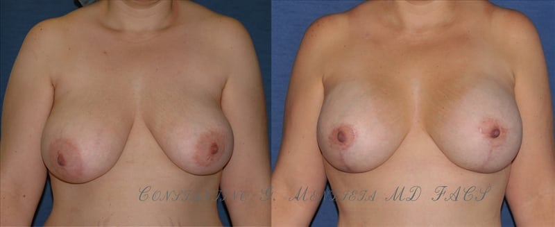 Breast Augmentation with Lift before-and-after photo — 4Beauty Aesthetic Institute