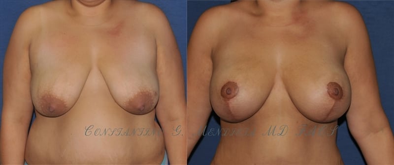 Breast Augmentation with Lift before-and-after photo — 4Beauty Aesthetic Institute