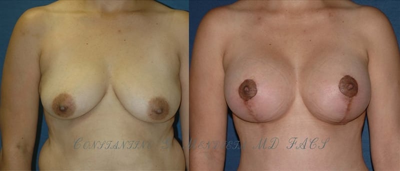 Breast Augmentation with Lift before-and-after photo — 4Beauty Aesthetic Institute