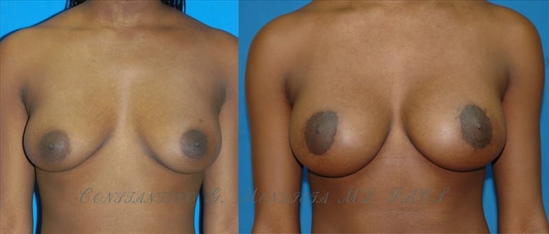 Breast Augmentation with Lift before-and-after photo — 4Beauty Aesthetic Institute