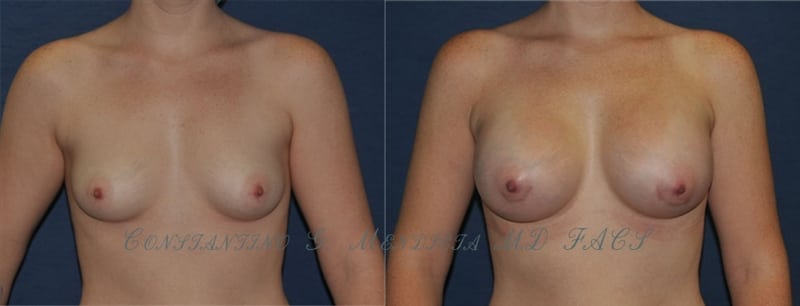 BREAST-AUGMENTATIONS-19-1