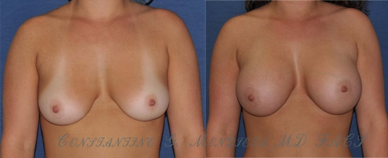 Breast Augmentation before-and-after photo — 4Beauty Aesthetic Institute