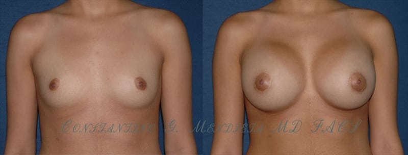 Breast Augmentation before-and-after photo — 4Beauty Aesthetic Institute