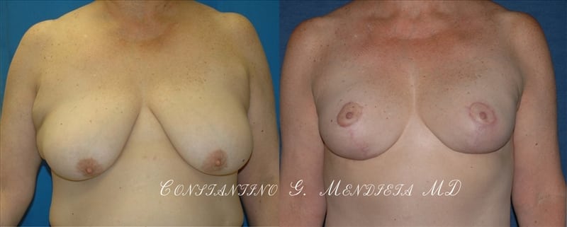 Breast Lift before-and-after photo — 4Beauty Aesthetic Institute