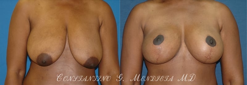 Breast Reduction before-and-after photo — 4Beauty Aesthetic Institute