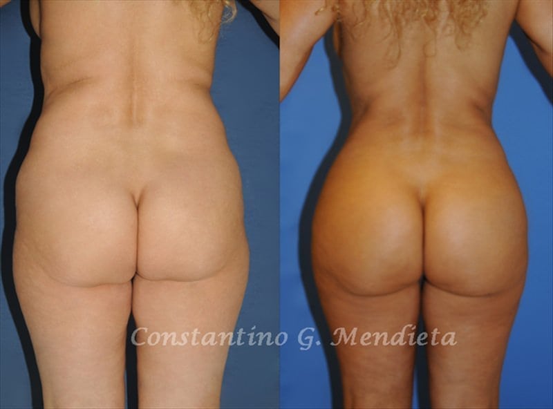 Fat Transfer & Brazilian Butt Lift before-and-after photo — 4Beauty Aesthetic Institute