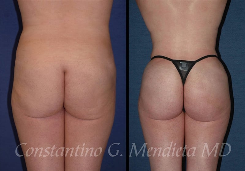 Fat Transfer & Brazilian Butt Lift before-and-after photo — 4Beauty Aesthetic Institute