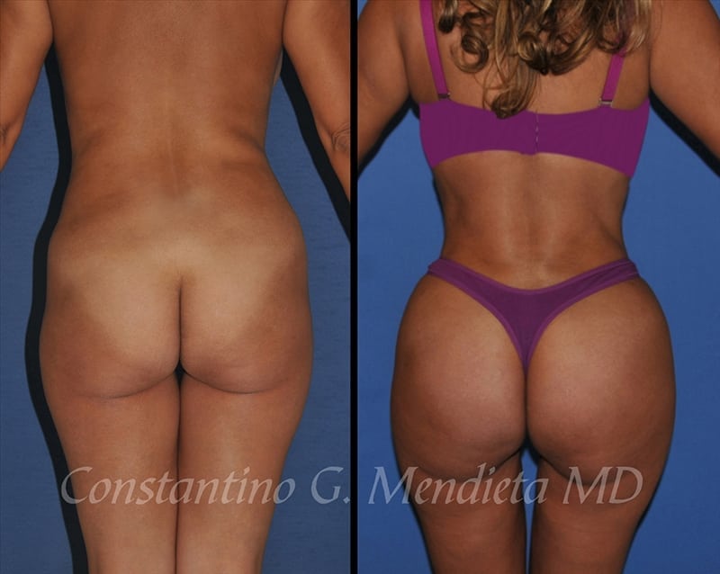 Fat Transfer & Brazilian Butt Lift before-and-after photo — 4Beauty Aesthetic Institute