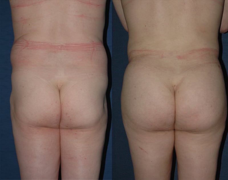 Fat Transfer & Brazilian Butt Lift before-and-after photo — 4Beauty Aesthetic Institute
