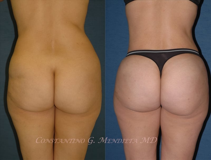 Fat Transfer & Brazilian Butt Lift before-and-after photo — 4Beauty Aesthetic Institute